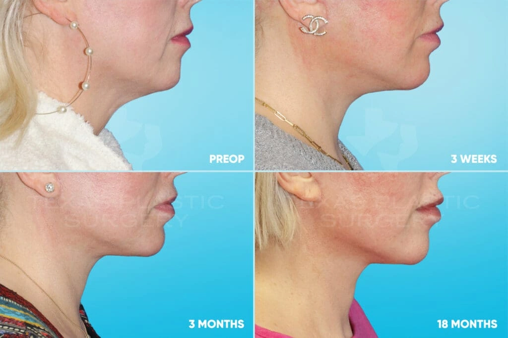 Real Patient results in San Antonio, TX Performed by Texas Plastic Surgery