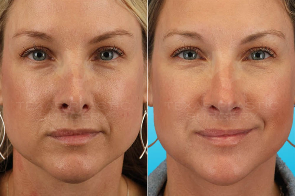 Real Patient results in San Antonio, TX Performed by Texas Plastic Surgery