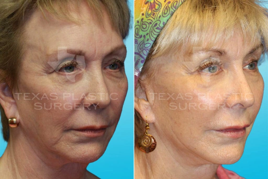 Real Patient results in San Antonio, TX Performed by Texas Plastic Surgery