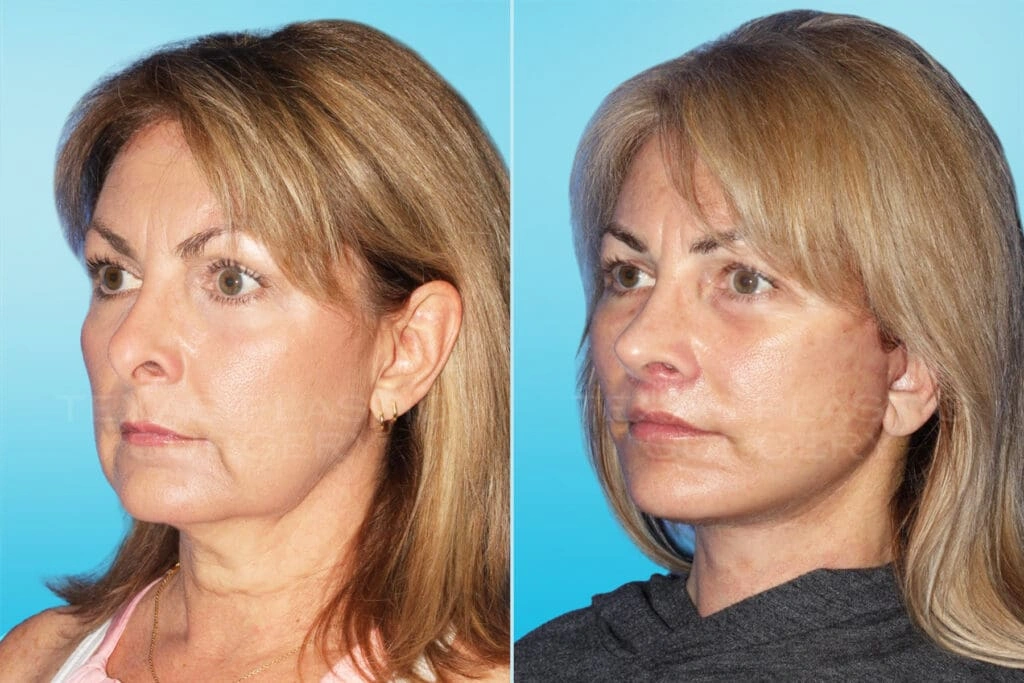 Real Patient results in San Antonio, TX Performed by Texas Plastic Surgery