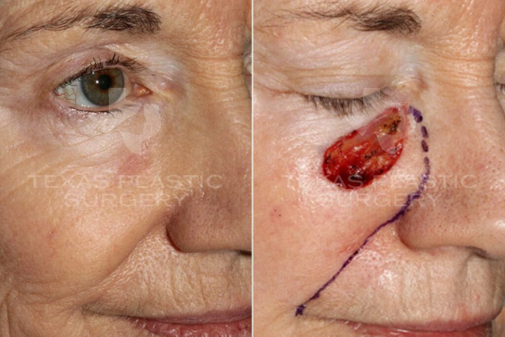 Real Patient results in San Antonio, TX Performed by Texas Plastic Surgery