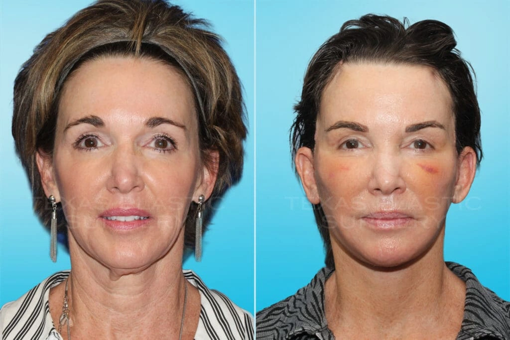 Real Patient results in San Antonio, TX Performed by Texas Plastic Surgery