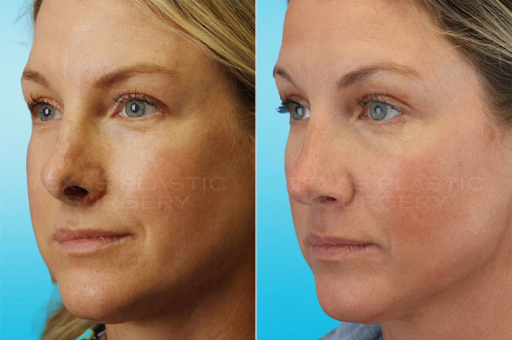 Real Patient results in San Antonio, TX Performed by Texas Plastic Surgery