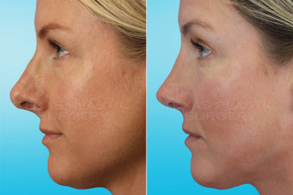Real Patient results in San Antonio, TX Performed by Texas Plastic Surgery