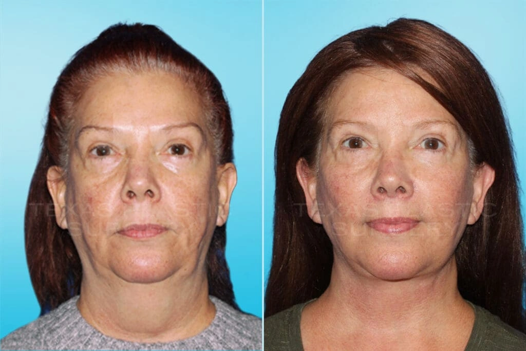 Real Patient results in San Antonio, TX Performed by Texas Plastic Surgery