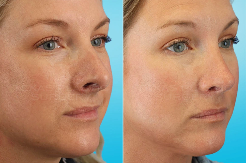 Real Patient results in San Antonio, TX Performed by Texas Plastic Surgery