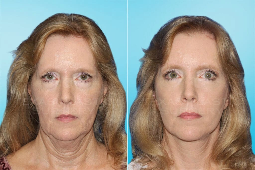 Real Patient results in San Antonio, TX Performed by Texas Plastic Surgery