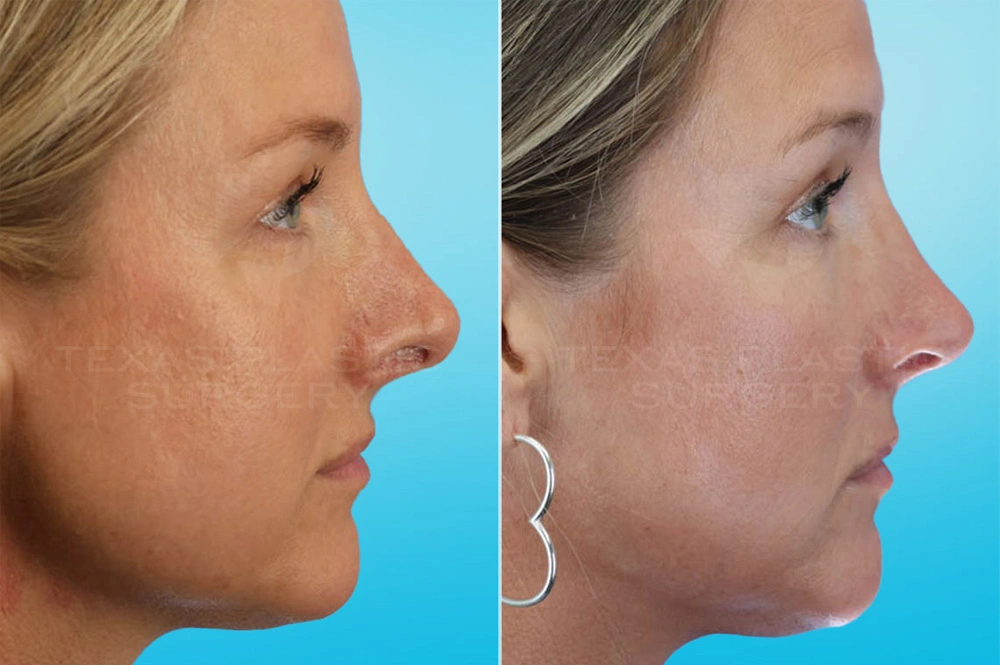 Real Patient results in San Antonio, TX Performed by Texas Plastic Surgery
