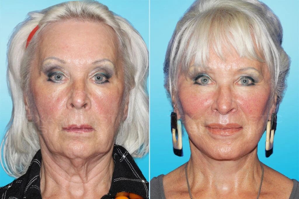 Real Patient results in San Antonio, TX Performed by Texas Plastic Surgery