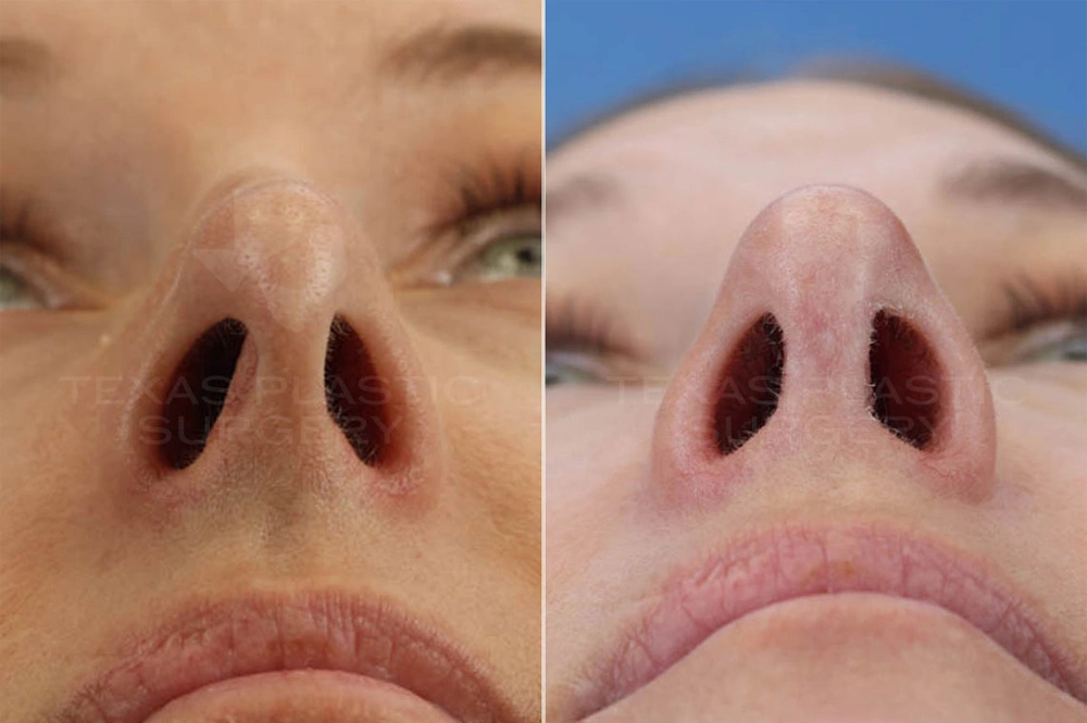 Real Patient results in San Antonio, TX Performed by Texas Plastic Surgery