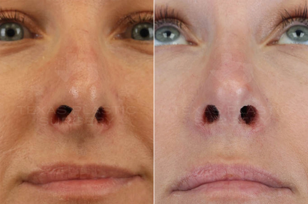 Real Patient results in San Antonio, TX Performed by Texas Plastic Surgery