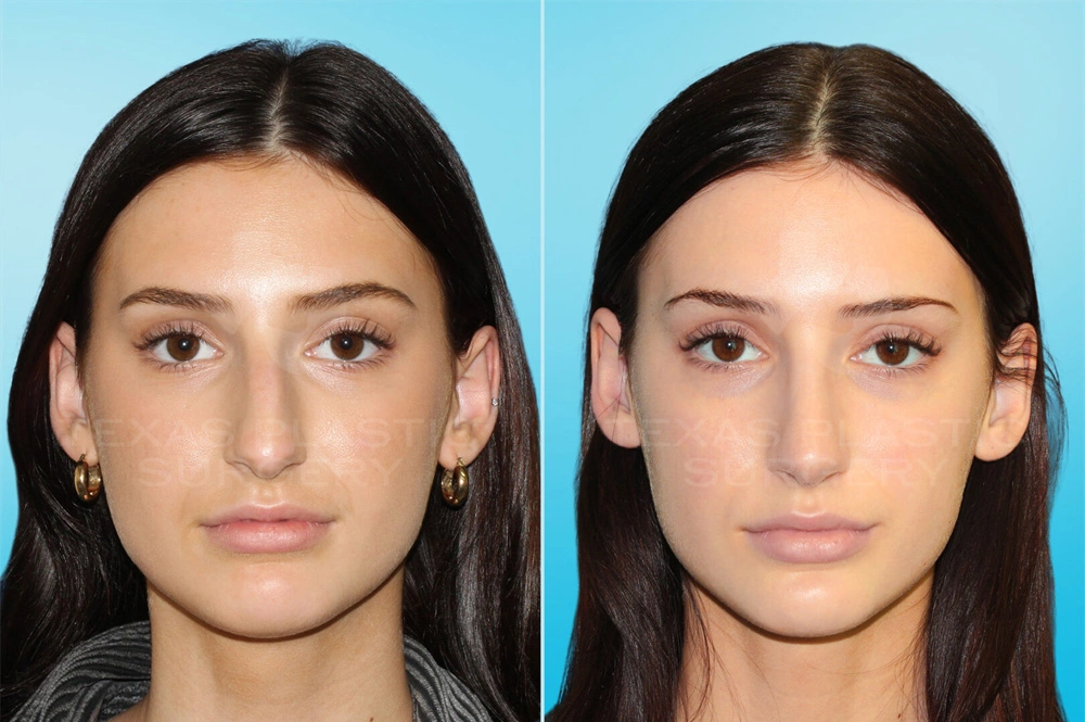 Real Patient results in San Antonio, TX Performed by Texas Plastic Surgery