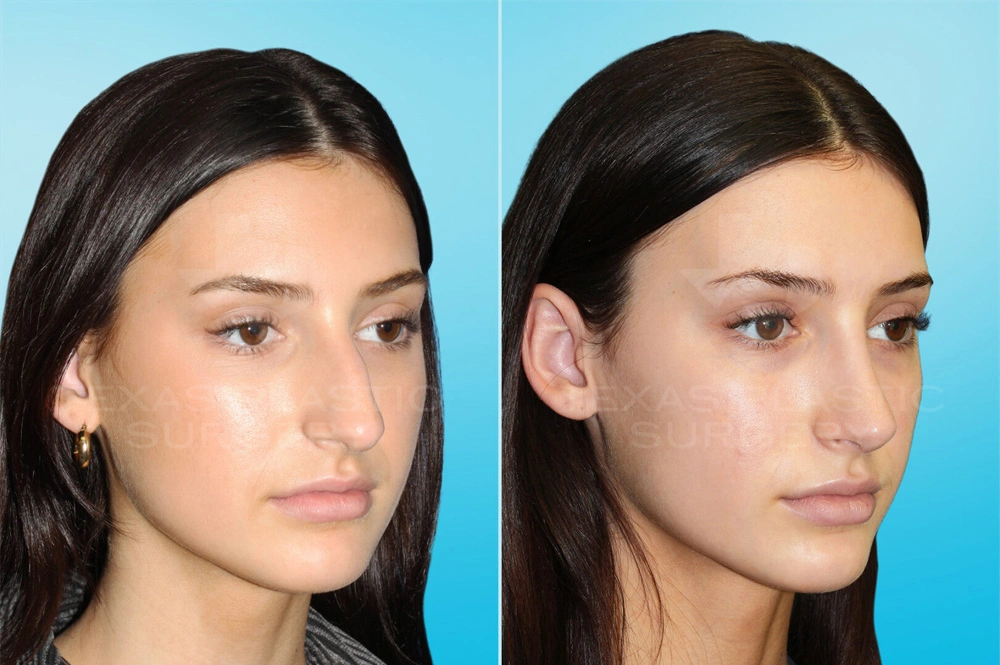 Real Patient results in San Antonio, TX Performed by Texas Plastic Surgery