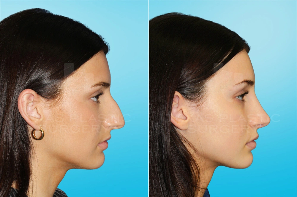 Real Patient results in San Antonio, TX Performed by Texas Plastic Surgery