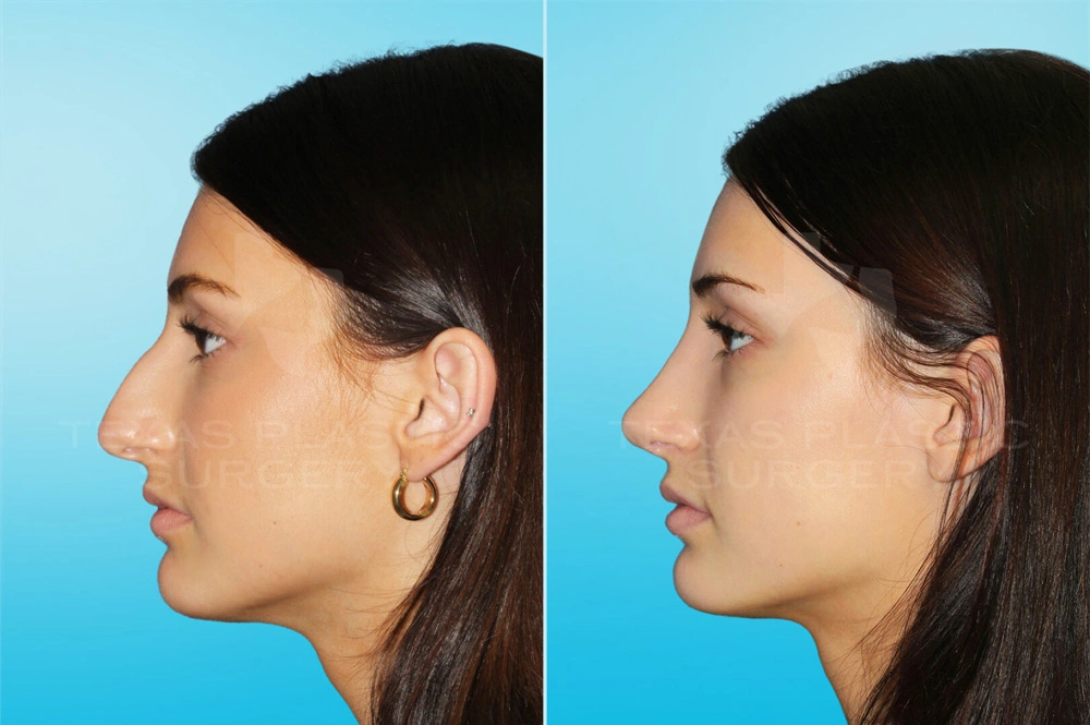 Real Patient results in San Antonio, TX Performed by Texas Plastic Surgery