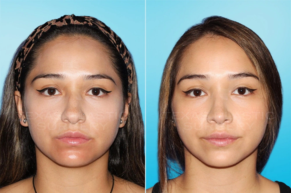 Real Patient results in San Antonio, TX Performed by Texas Plastic Surgery