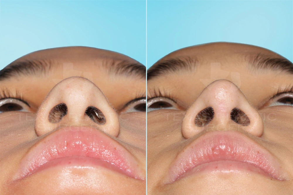 Real Patient results in San Antonio, TX Performed by Texas Plastic Surgery