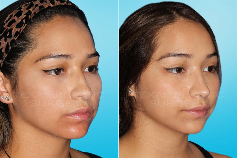 Real Patient results in San Antonio, TX Performed by Texas Plastic Surgery