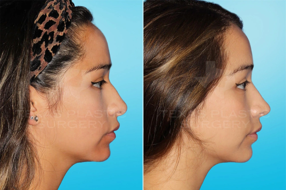 Real Patient results in San Antonio, TX Performed by Texas Plastic Surgery