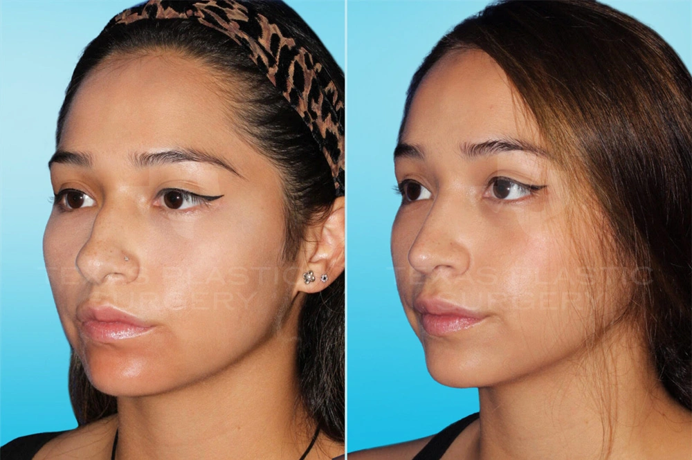 Real Patient results in San Antonio, TX Performed by Texas Plastic Surgery