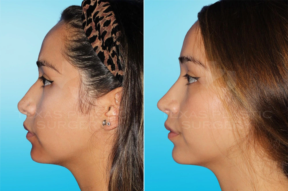 Real Patient results in San Antonio, TX Performed by Texas Plastic Surgery