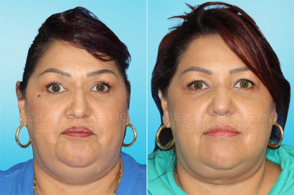 Real Patient results in San Antonio, TX Performed by Texas Plastic Surgery