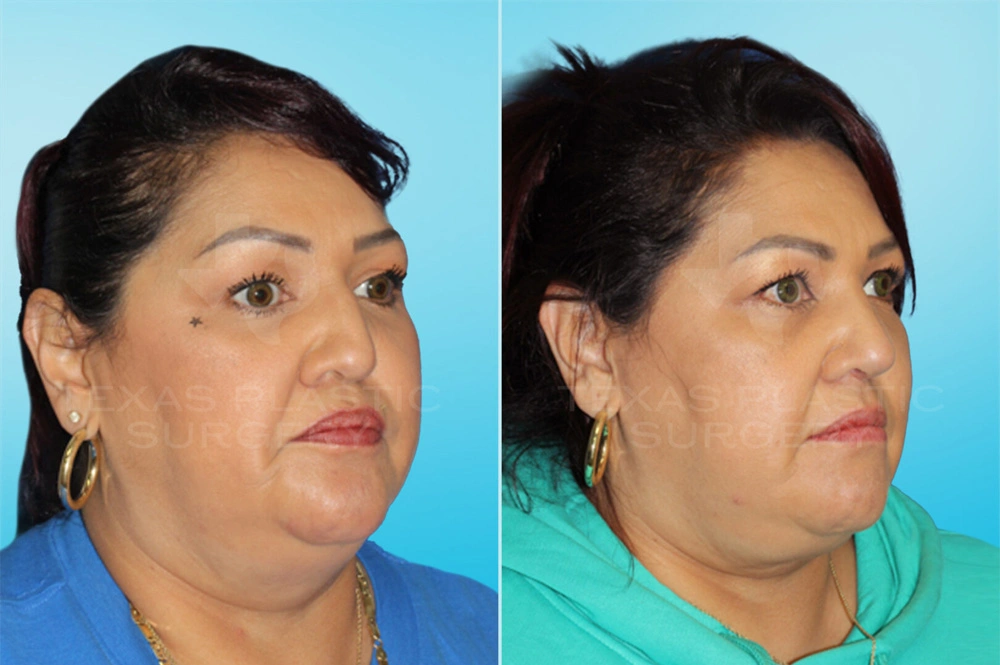 Real Patient results in San Antonio, TX Performed by Texas Plastic Surgery