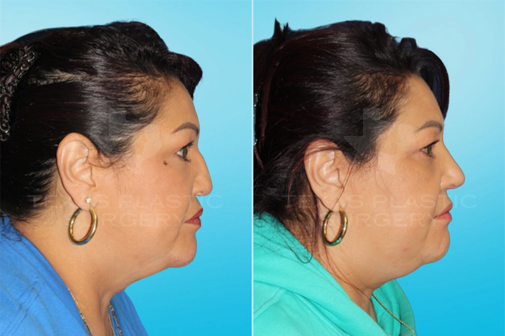 Real Patient results in San Antonio, TX Performed by Texas Plastic Surgery