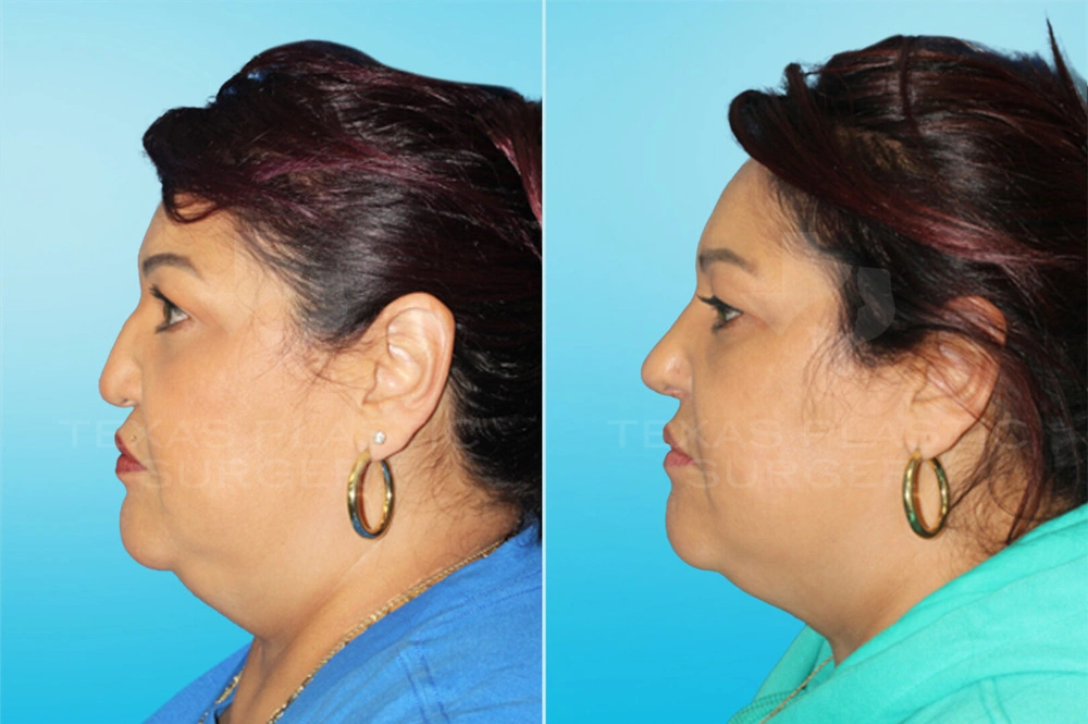 Real Patient results in San Antonio, TX Performed by Texas Plastic Surgery