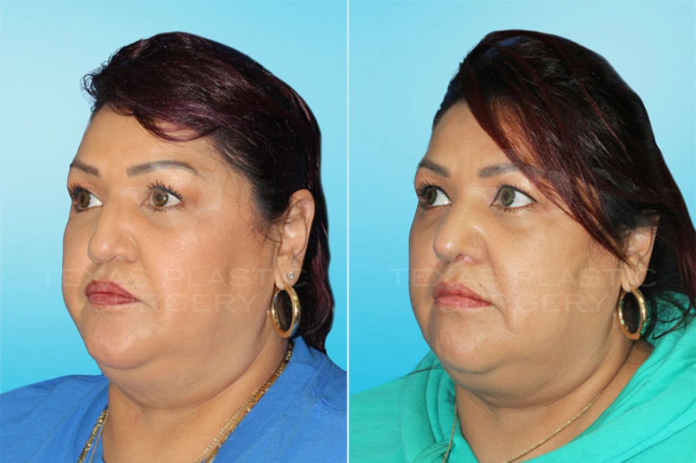 Real Patient results in San Antonio, TX Performed by Texas Plastic Surgery