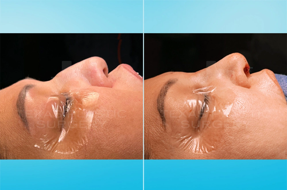 Real Patient results in San Antonio, TX Performed by Texas Plastic Surgery