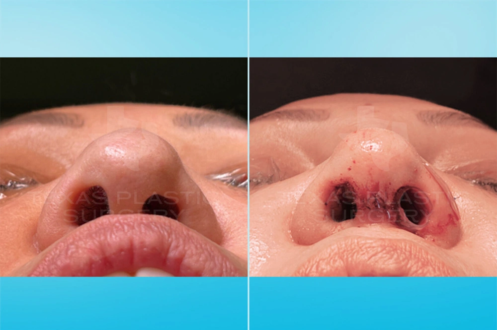 Real Patient results in San Antonio, TX Performed by Texas Plastic Surgery