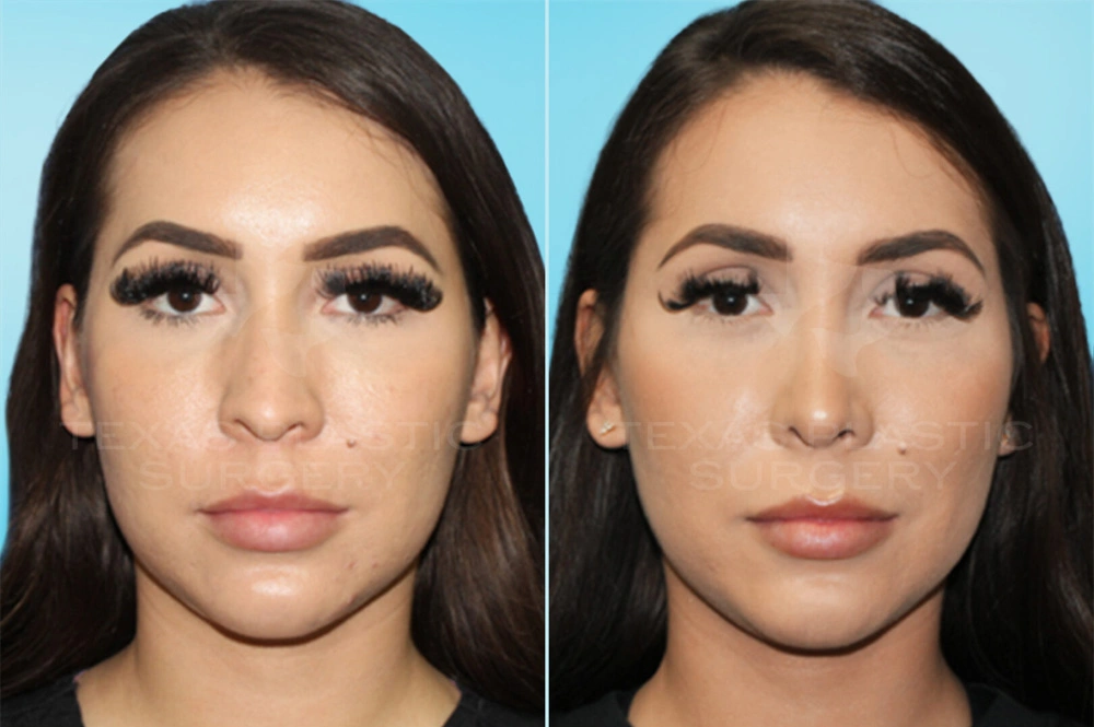 Real Patient results in San Antonio, TX Performed by Texas Plastic Surgery