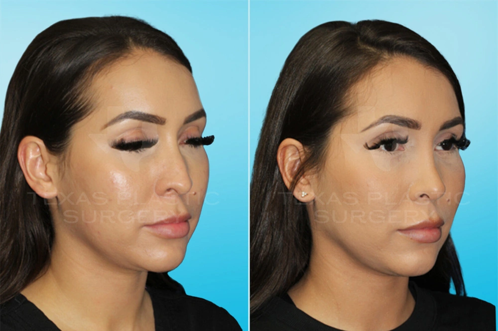 Real Patient results in San Antonio, TX Performed by Texas Plastic Surgery