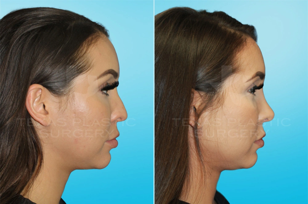 Real Patient results in San Antonio, TX Performed by Texas Plastic Surgery