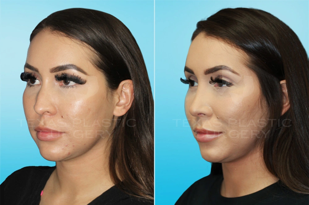 Real Patient results in San Antonio, TX Performed by Texas Plastic Surgery