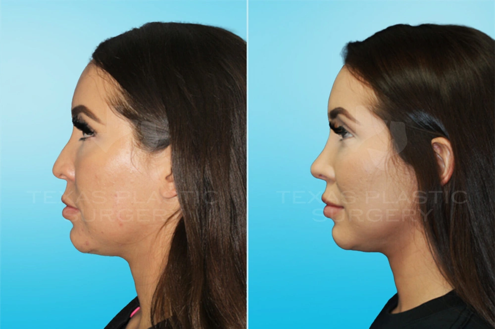 Real Patient results in San Antonio, TX Performed by Texas Plastic Surgery