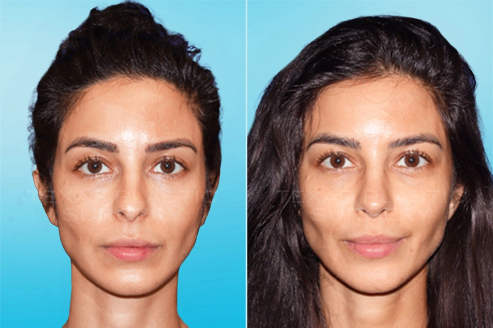 Real Patient results in San Antonio, TX Performed by Texas Plastic Surgery