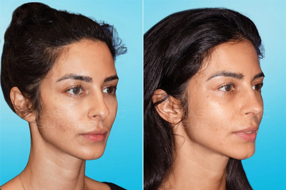 Real Patient results in San Antonio, TX Performed by Texas Plastic Surgery