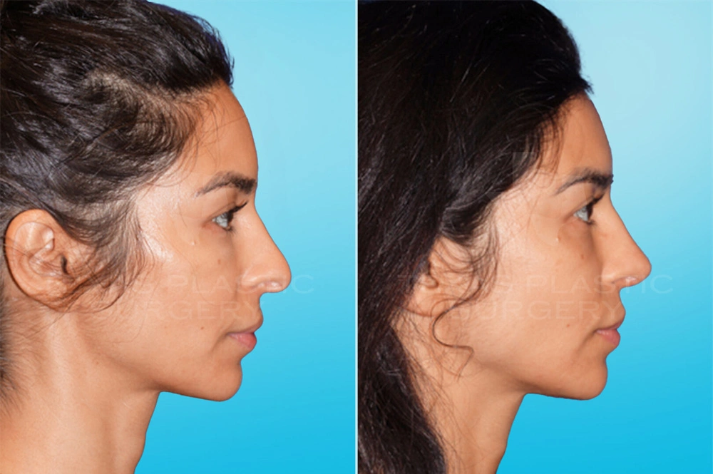 Real Patient results in San Antonio, TX Performed by Texas Plastic Surgery