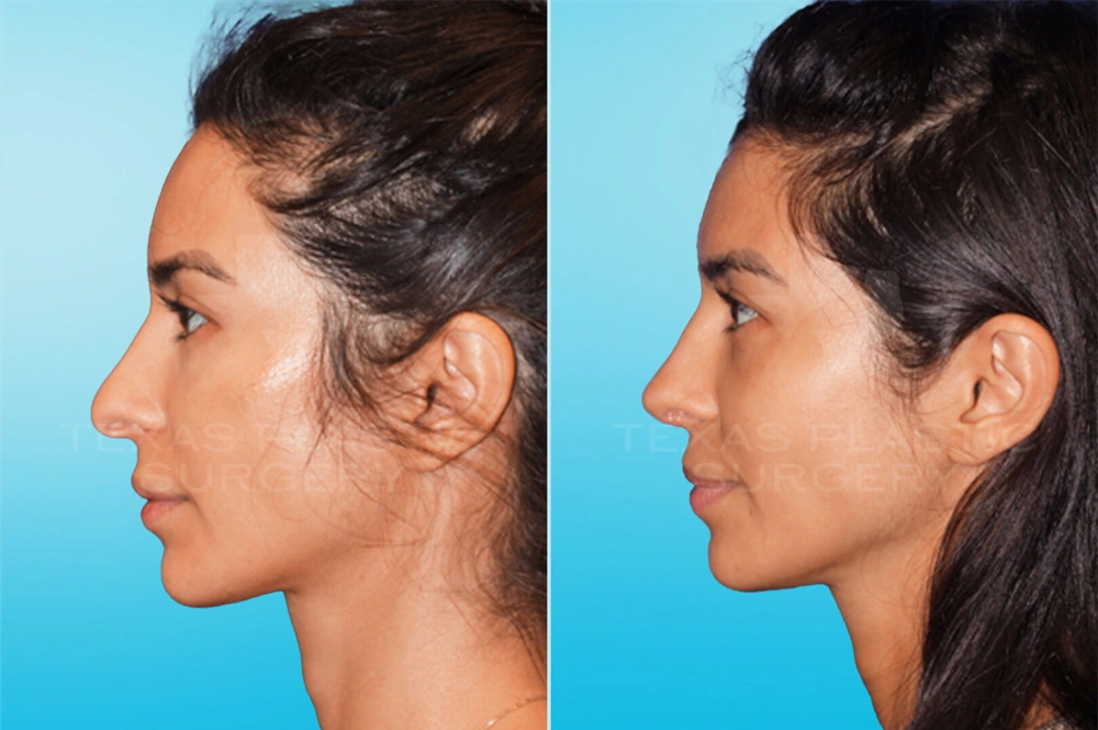 Real Patient results in San Antonio, TX Performed by Texas Plastic Surgery