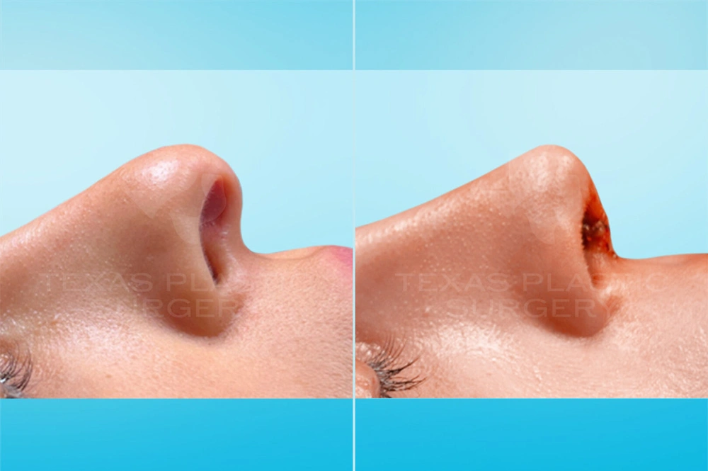 Real Patient results in San Antonio, TX Performed by Texas Plastic Surgery