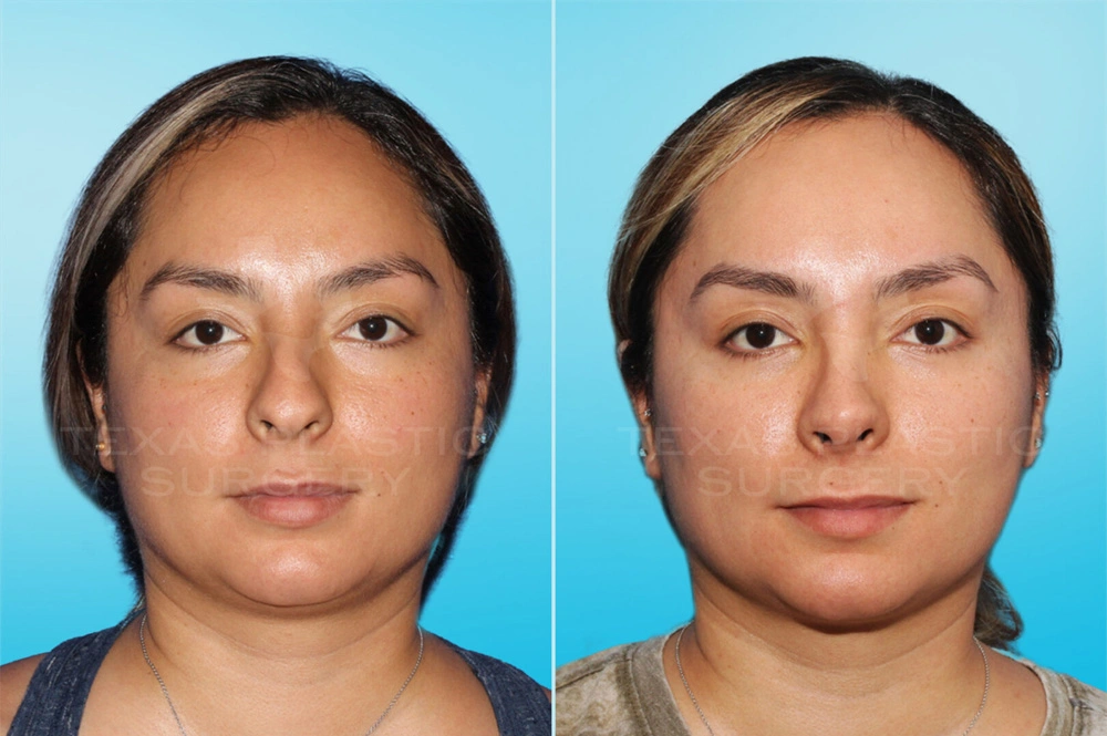 Real Patient results in San Antonio, TX Performed by Texas Plastic Surgery