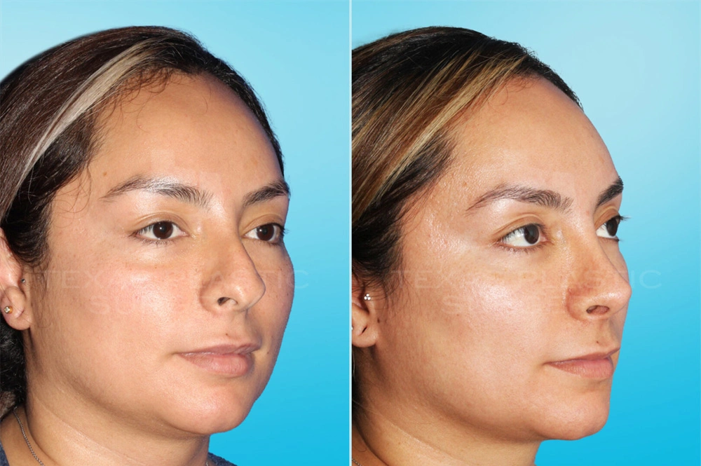 Real Patient results in San Antonio, TX Performed by Texas Plastic Surgery