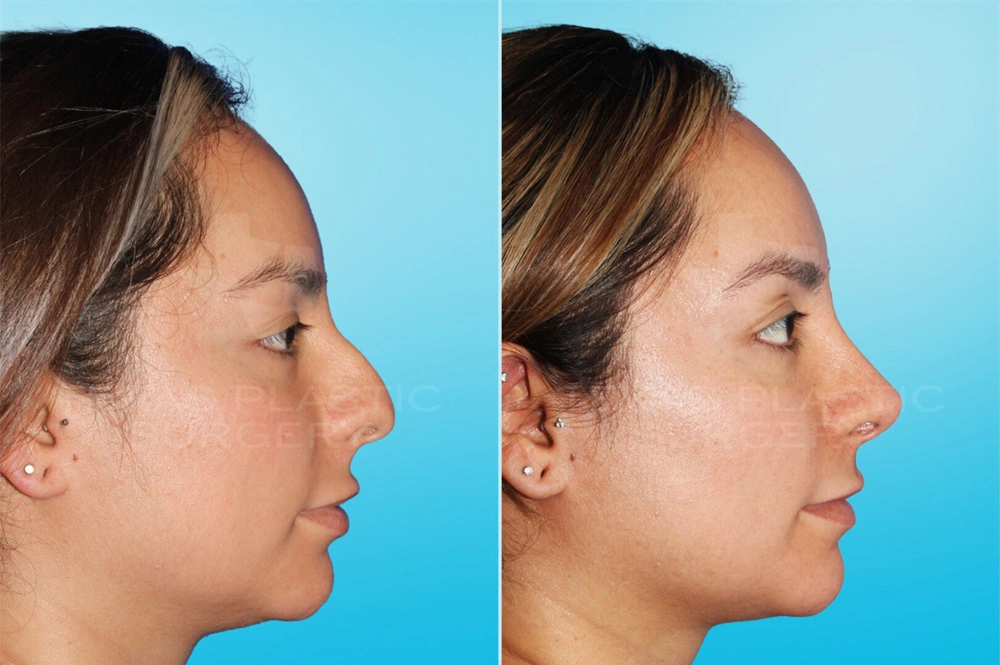 Real Patient results in San Antonio, TX Performed by Texas Plastic Surgery