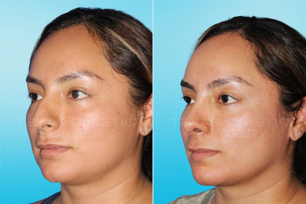 Real Patient results in San Antonio, TX Performed by Texas Plastic Surgery