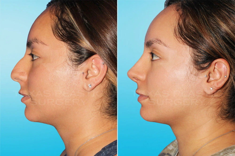 Real Patient results in San Antonio, TX Performed by Texas Plastic Surgery