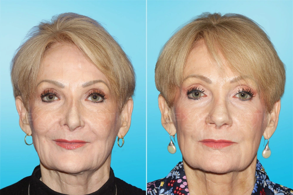 Real Patient results in San Antonio, TX Performed by Texas Plastic Surgery