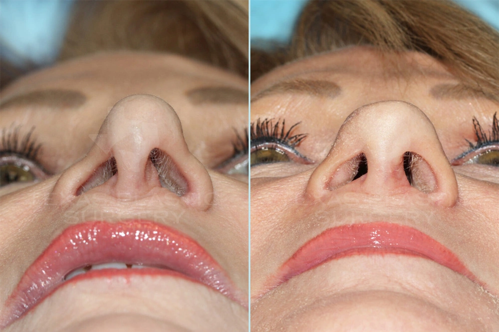 Real Patient results in San Antonio, TX Performed by Texas Plastic Surgery