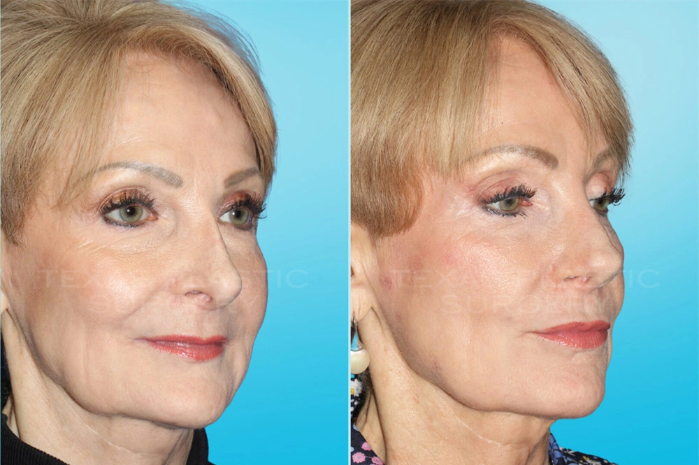 Real Patient results in San Antonio, TX Performed by Texas Plastic Surgery